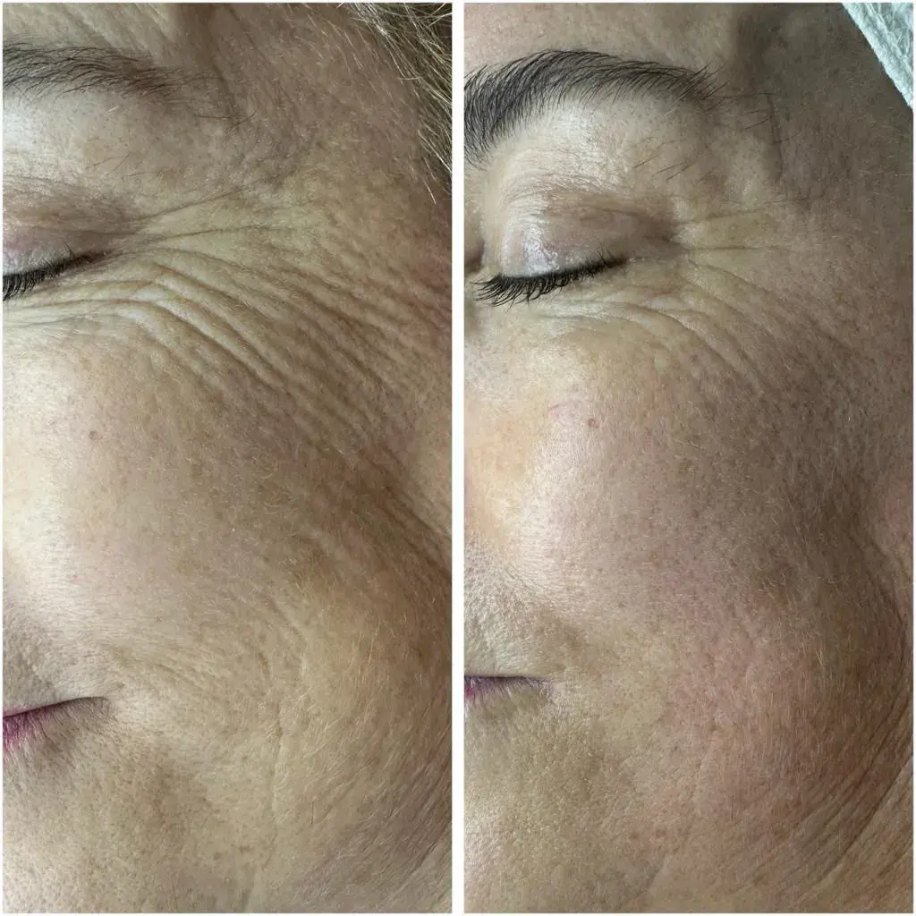 A client's eye area before and after