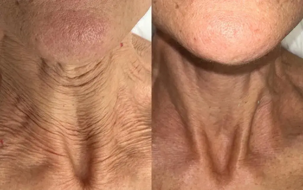 A Blue Rose client, before and after