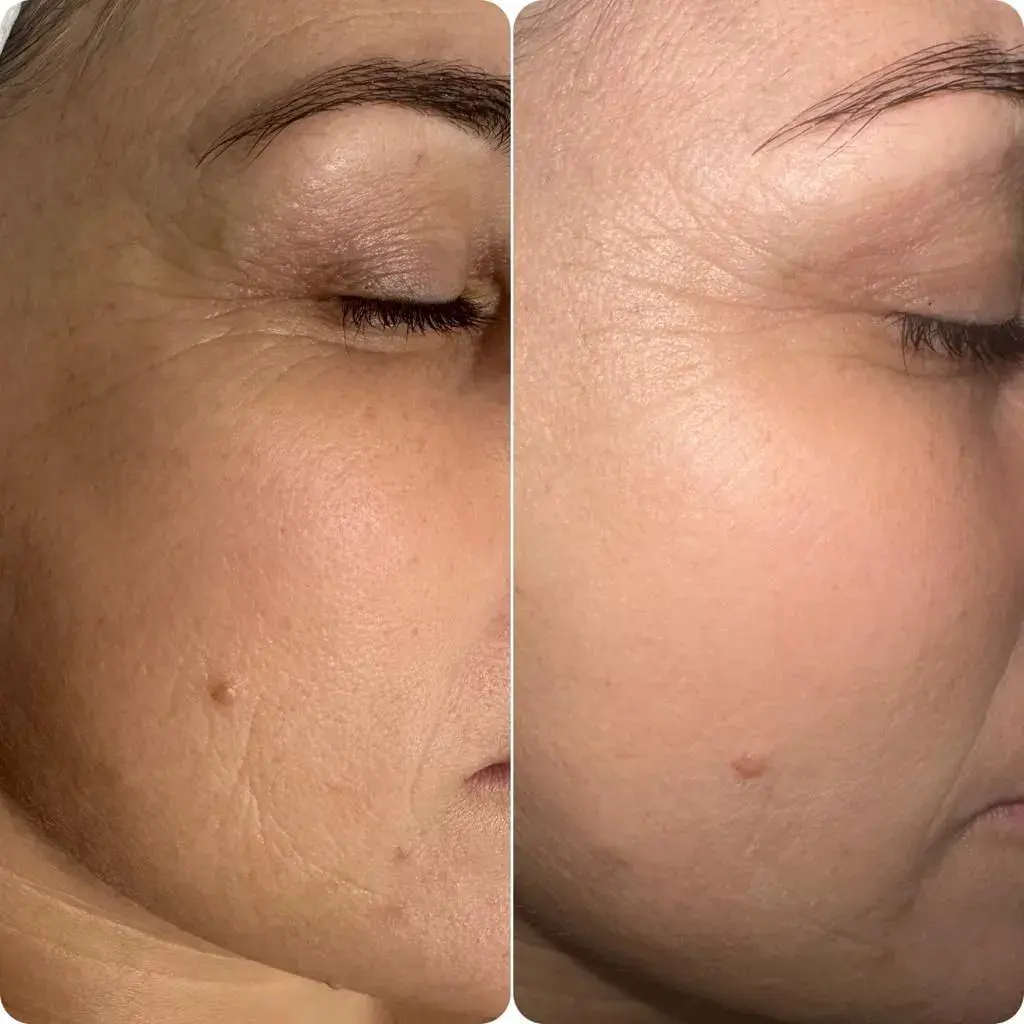 A client's cheek and eye area before and after