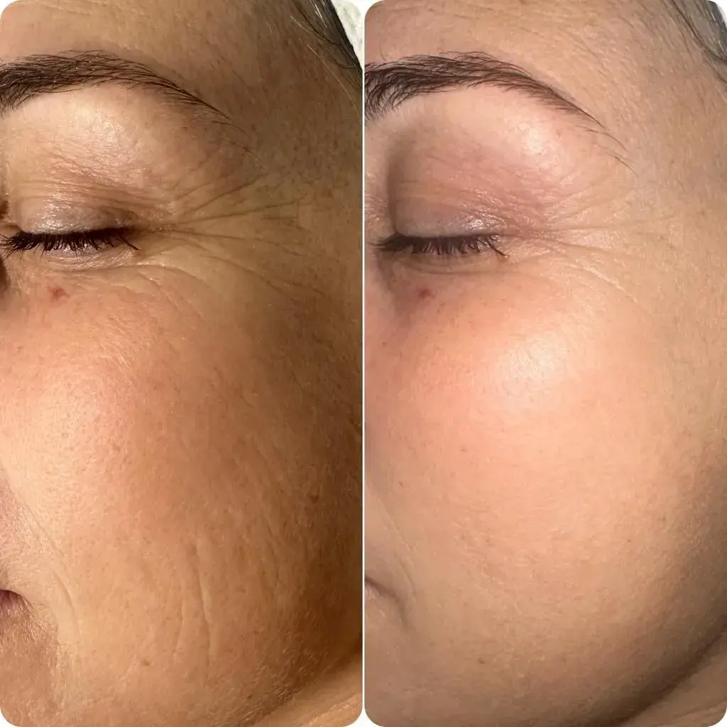 A client's periocular area before and after